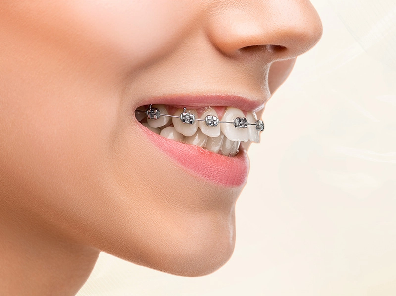 Niềng Răng Mắc Cài Kim Loại