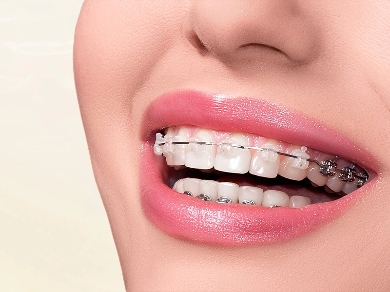 Niềng Răng Mắc Cài Sứ/Pha Lê