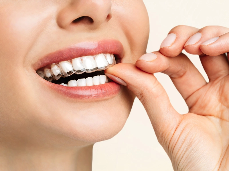 Niềng Răng Trong Suốt Invisalign