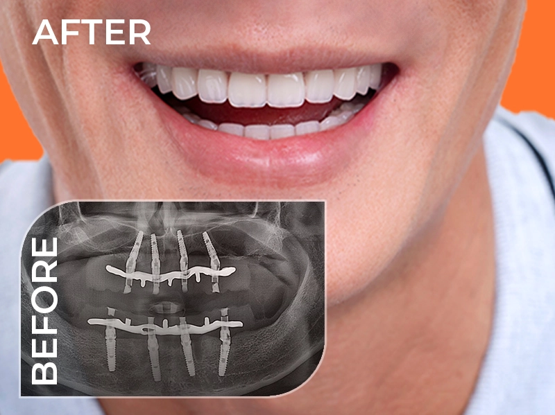 Tỷ lệ thành công của ca cấy ghép lên đến 99%