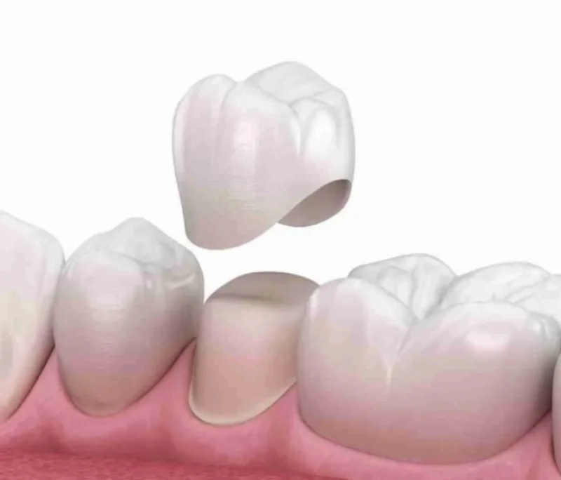 3 dấu hiệu cho thấy bạn cần làm lại răng sứ ngay lập tức