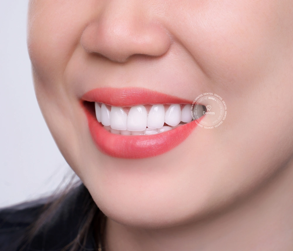 Bọc răng sứ hết bao nhiêu tiền? Tips chọn nha khoa uy tín làm răng sứ