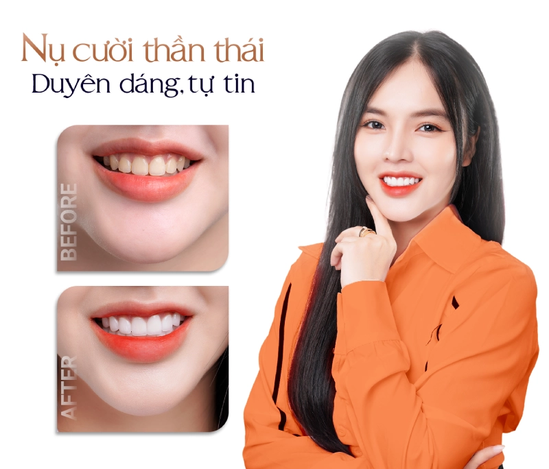 Bọc răng sứ thẩm mỹ là gì? Khi nào nên bọc? Bọc có tốt không? Giá bao nhiêu?