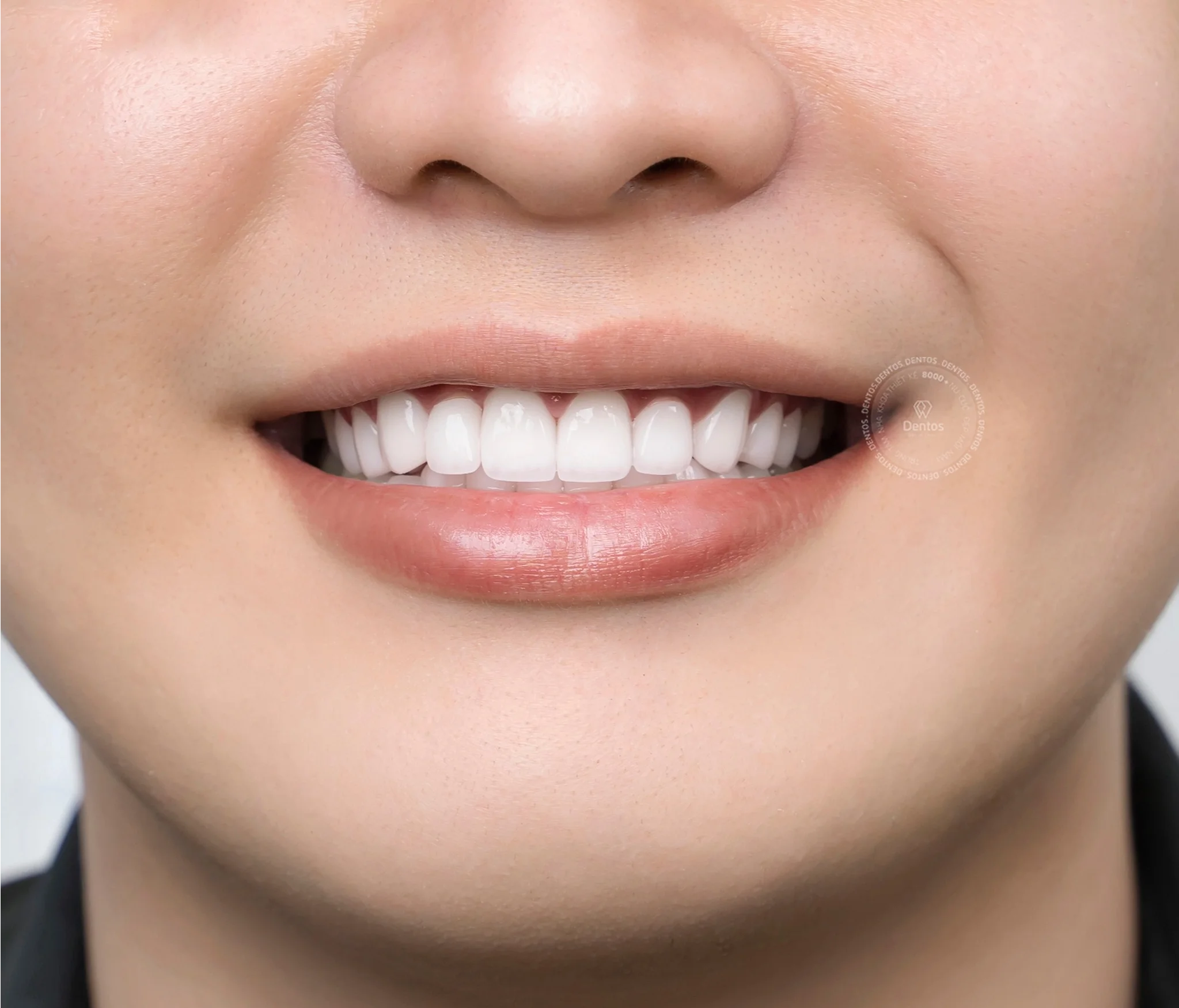 Răng sứ Cercon HT là gì? Bọc răng sứ Cercon HT giá bao nhiêu?