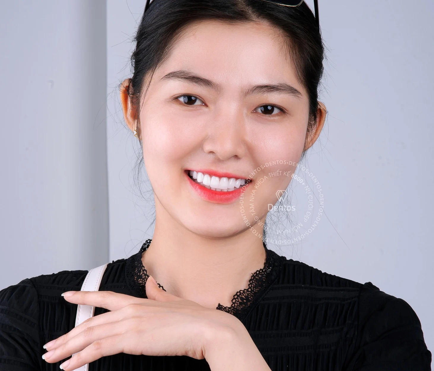 Bảng giá răng sứ Zirconia 2024 tại Dentos - Bọc răng sứ Zirconia có tốt không?