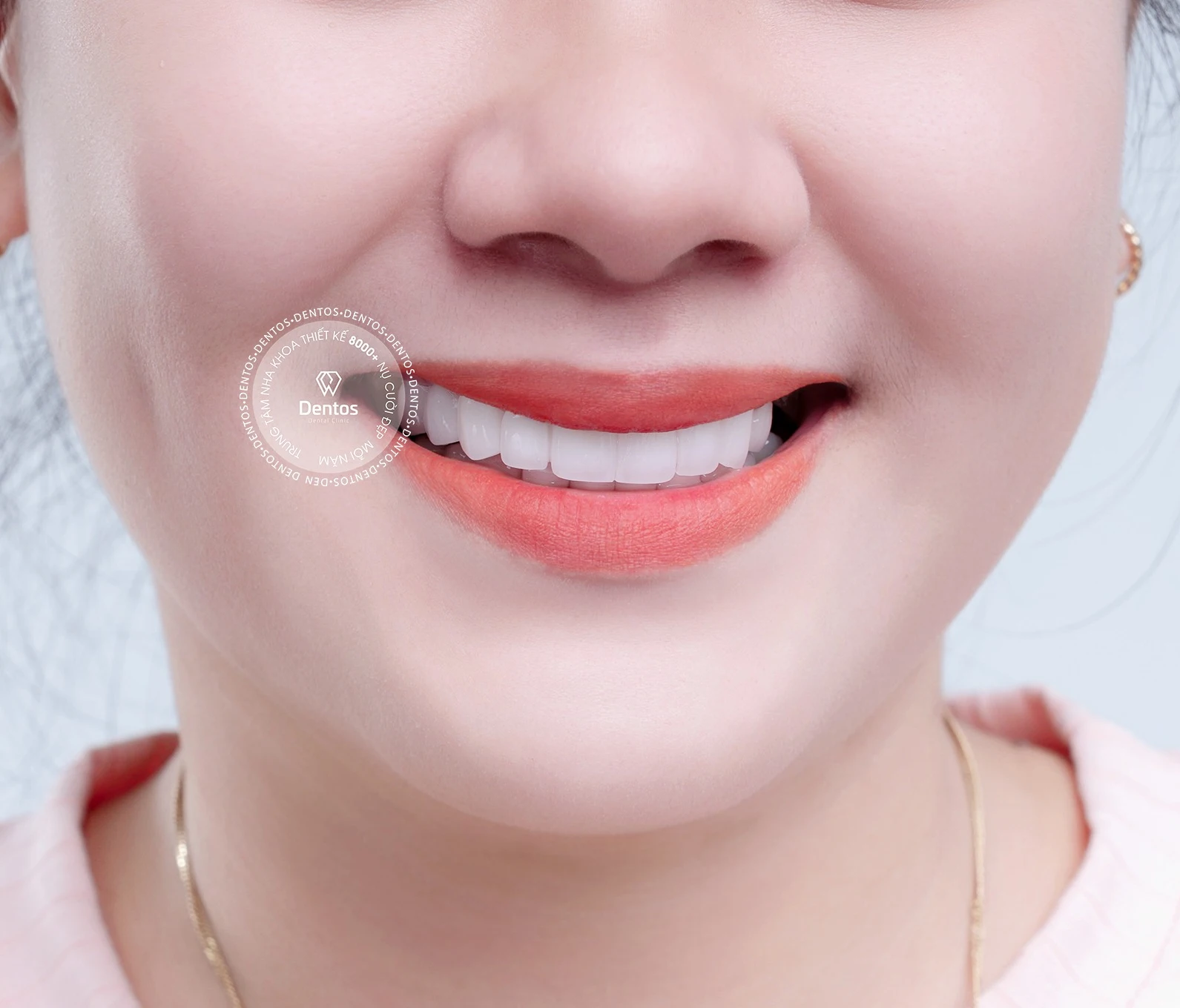 Giá răng sứ thường bao nhiêu tiền? Bọc răng sứ thường có bị hôi miệng?