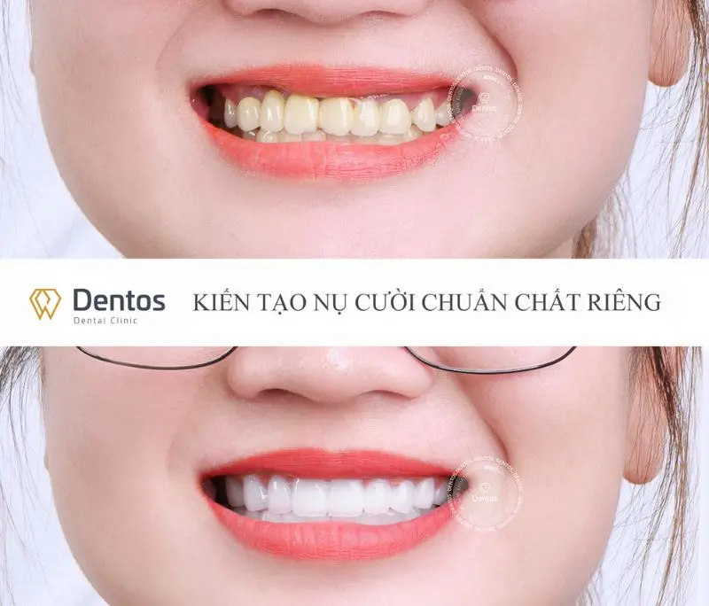 Bọc răng sứ giá bao nhiêu? Có nên bọc răng sứ giá rẻ?