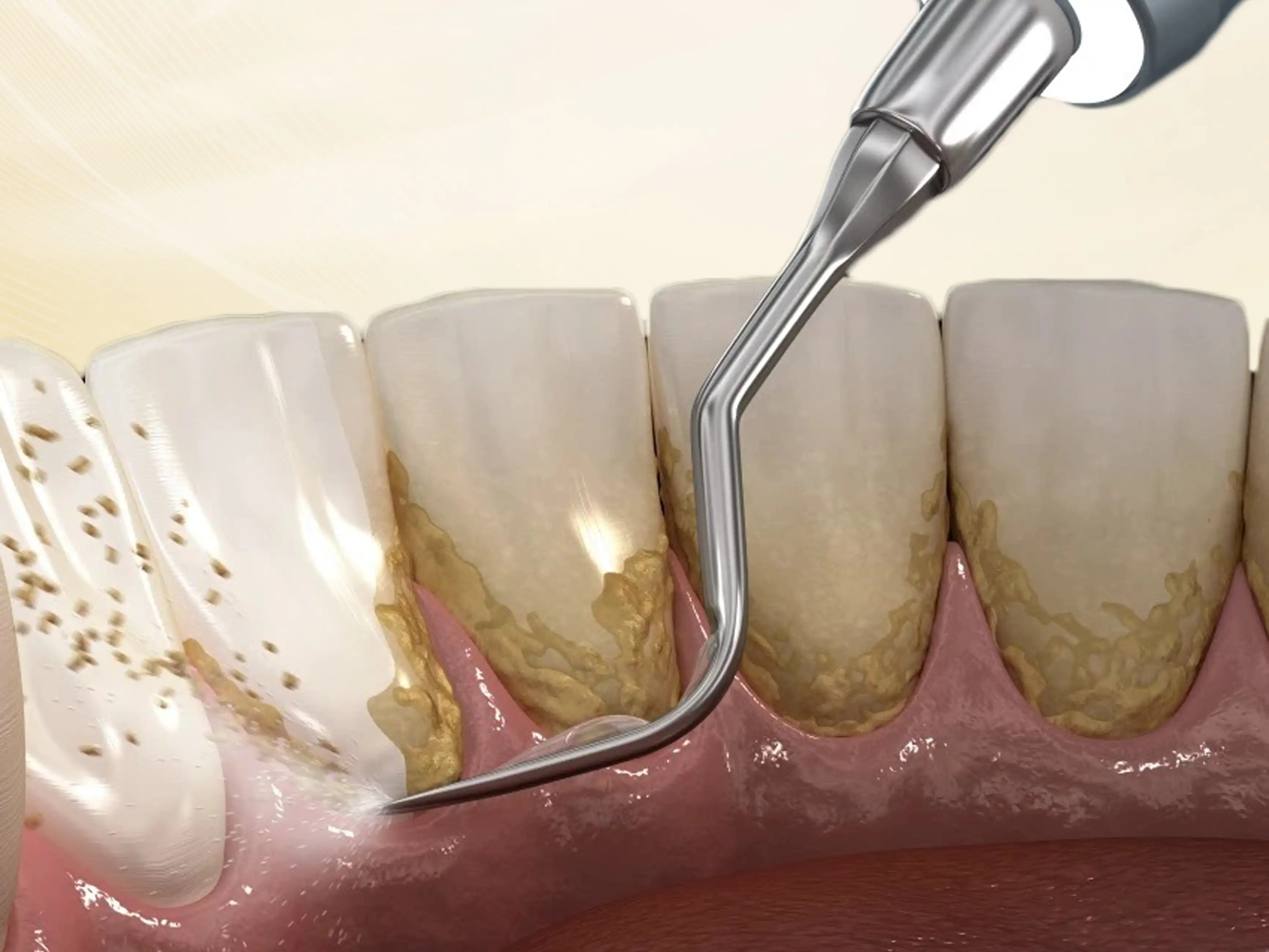 Máy Cạo Vôi Răng Siêu Âm