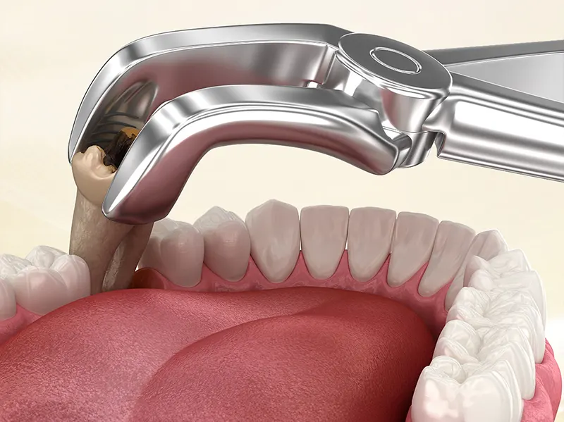 Nhổ Răng: Không Chỉ Là Lấy Đi Răng Hỏng!