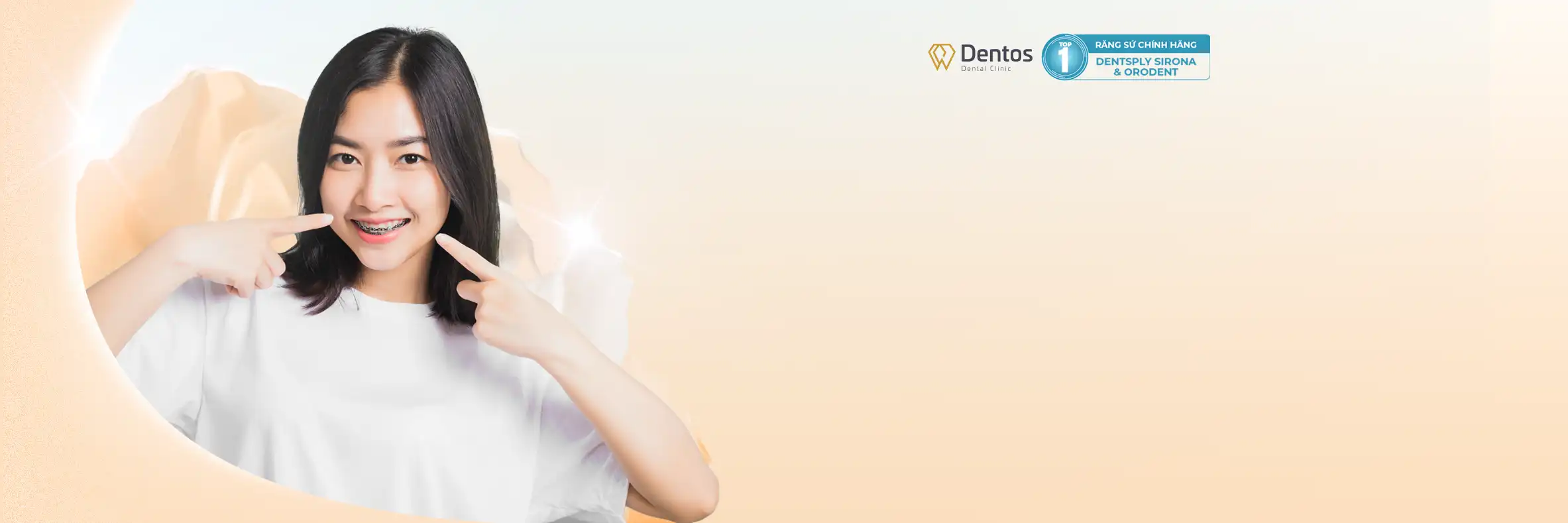 Niềng Răng Mắc Cài