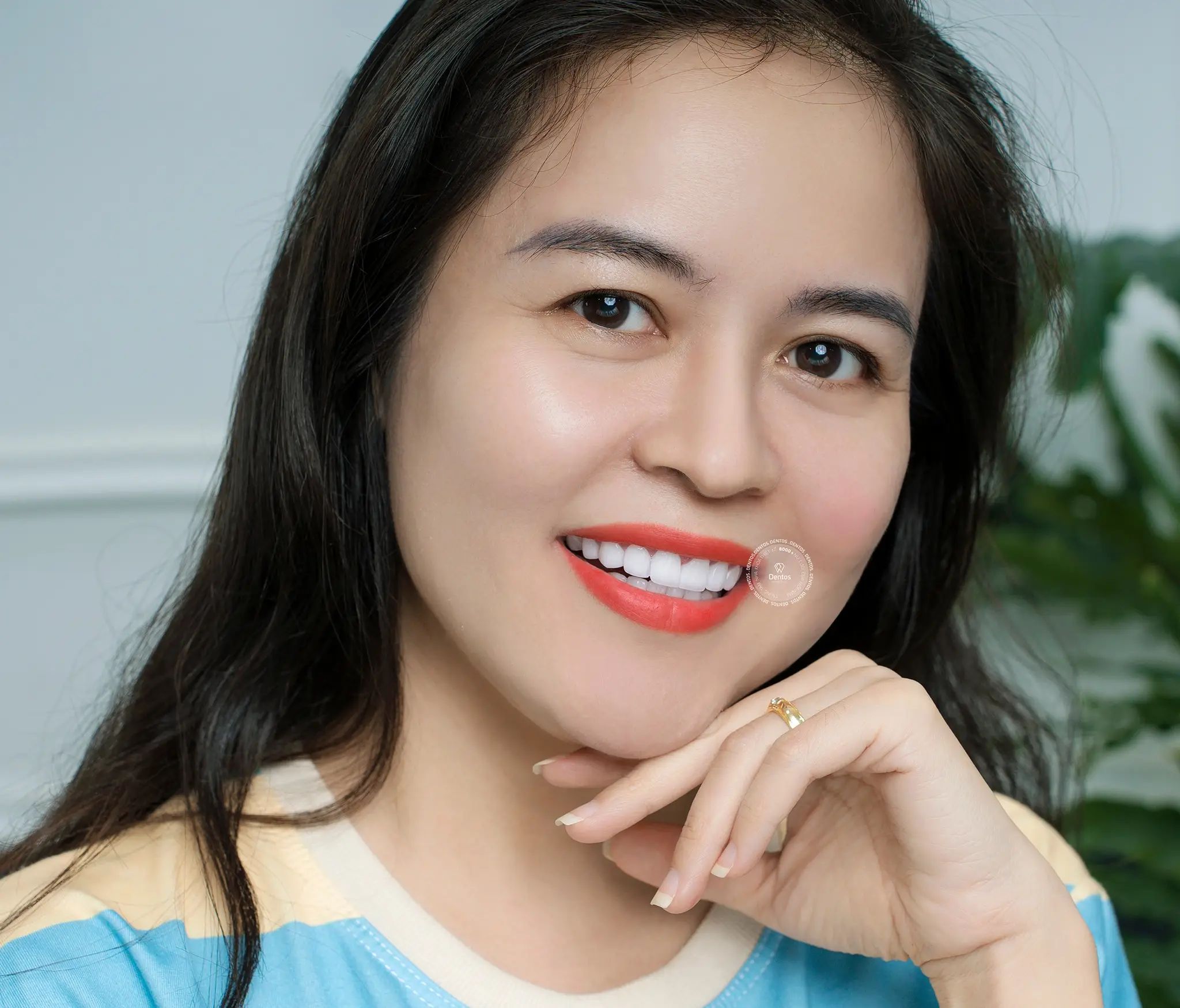 Răng sứ DDBio có tốt không? Cách nhận biết? Khi nào nên bọc?