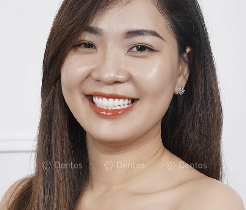 Điều gì khiến bạn lo ngại khi làm răng sứ?