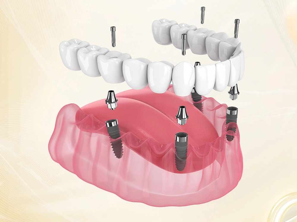 Implant Toàn Hàm All-On-4