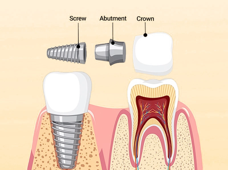 Cấy Implant: Giải Pháp Y Khoa Tái Tạo Chân Răng Đã Mất