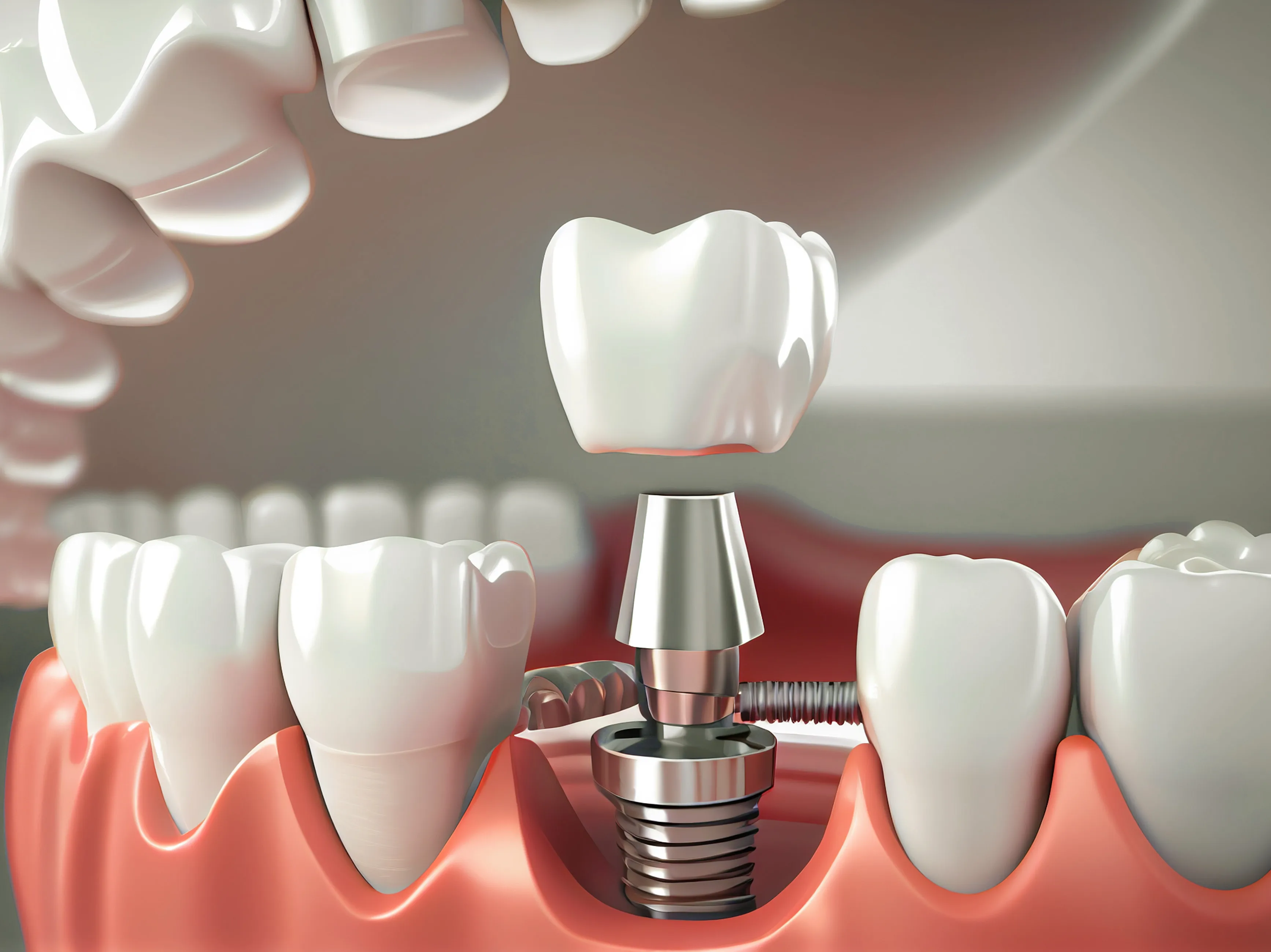 Trụ Implant Dentium Có Phù Hợp Với Bạn?