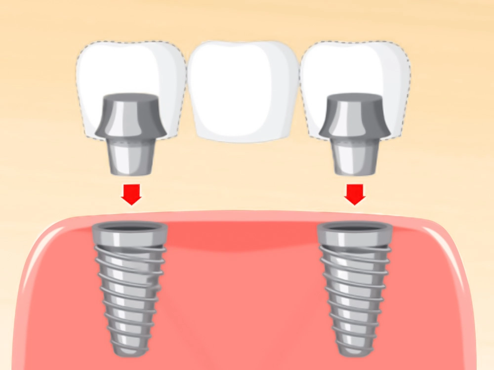Cầu Răng Implant