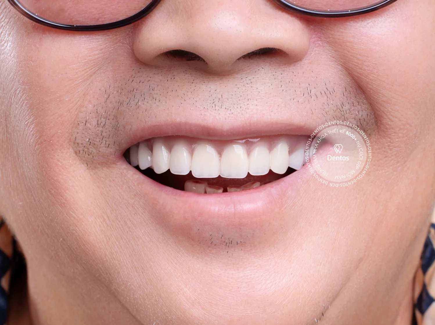 Trồng Răng Implant Mất Bao Lâu?